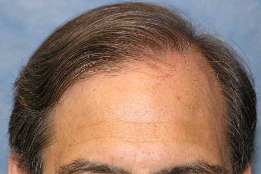 Click image for larger version

Name:	05_after-2nd-hair-transplant.jpg

Size:	60.4 KB
ID:	8032