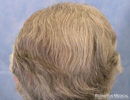 Bernstein Medical's Patient ZLA after 1st hair transplant - Back View 
 
View his full photoset >>...