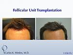 Before/After 1358 grafts to hairline and part line with Dr. Wesley in NYC. 
 
The softening of the hairline can be accomplished with relatively few...