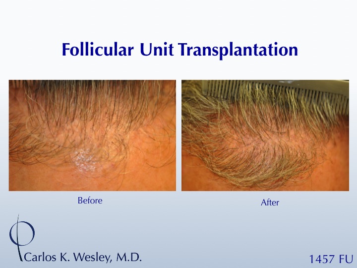This patient presented to Dr. Carlos K. Wesley (NYC) after having undergone a hair transplant session at a different surgical office.  He was pleased...