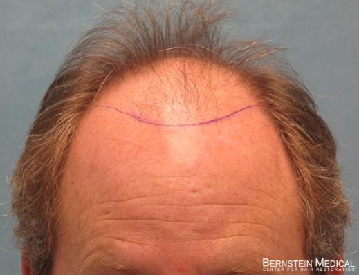 Bernstein Medical's Patient FVR Position of Planned Hairline - Detail of Hairline 
 
View his full photoset >>...