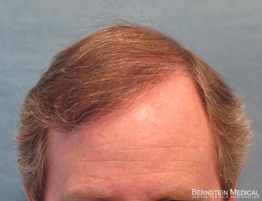 Bernstein Medical's Patient FVR, hair transplant results after one session - Detail of Hairline 
 
View his full photoset >>...