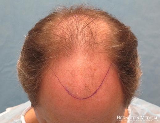 Bernstein Medical's Patient FVR, proposed hairline - Top View 
 
View his full photoset >>...