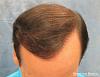 Result after two hair transplant procedures - Top View 
 
View his full photoset >>...