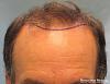 Position of Planned Hairline - Detail of Hairline 
 
View his full photoset >>...