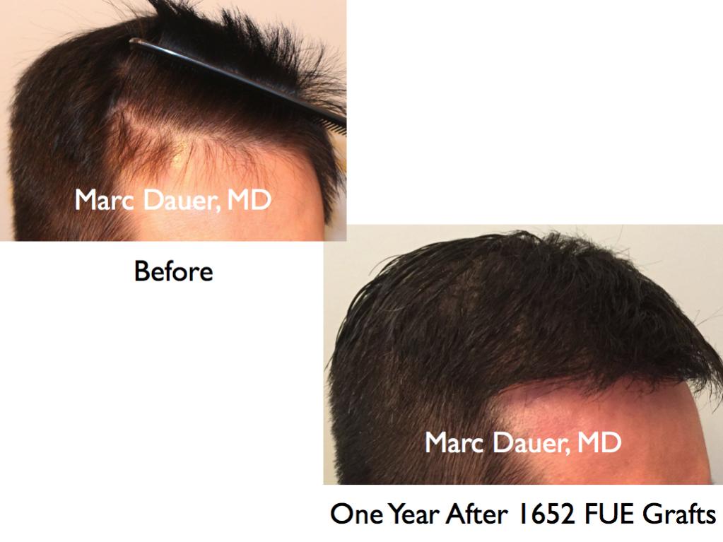 Click image for larger version

Name:	Hair Transplant Slides8.337.jpg

Size:	64.5 KB
ID:	35942