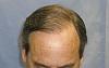 Click image for larger version

Name:	Top of Head and Hair Line This is After First Session.jpg

Size:	19.5 KB
ID:	352