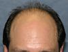 Click image for larger version

Name:	03_before-hair-transplant.jpg

Size:	50.0 KB
ID:	7896