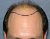 Click image for larger version

Name:	04_position-of-hairline.jpg

Size:	52.2 KB
ID:	7897