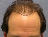 Click image for larger version

Name:	06_position-of-hairline-2nd-hair-transplant.jpg

Size:	55.0 KB
ID:	7899