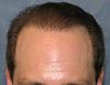 Click image for larger version

Name:	07_after-2nd-hair-transplant.jpg

Size:	50.9 KB
ID:	7900