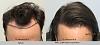 This Patient had 1,999 grafts FUE at the hairline, equivalent to 4,219 hairs. Notice how natural it looks. Dr Behnam