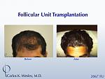 Before/After images of this 35-yr-old patient after a 2567-graft treatment by Dr. Carlos K. Wesley.  
 
A video of his transformation may be viewed...