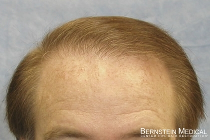 Click image for larger version

Name:	2-hairline.jpg

Size:	68.4 KB
ID:	39616