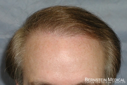 Click image for larger version

Name:	3-hairline.jpg

Size:	80.8 KB
ID:	39617