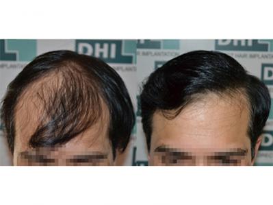 Mr. Kamlesh 3690 Hair implanted 9 month result