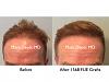 Click image for larger version

Name:	Hair Transplant Slides copy91.001.jpg

Size:	12.2 KB
ID:	47904