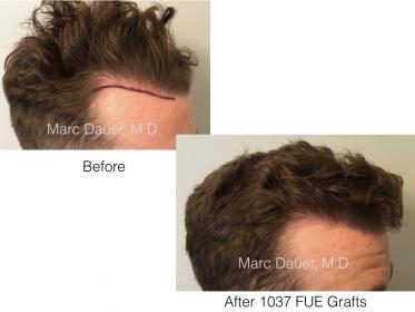 1037 FUE Grafts