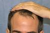Detail of Hairline - Before Hair Transplant 
 
View his full photoset >>...