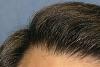 Detail of Hairline - Close-up After 1st Hair Transplant Session 
 
View his full photoset >>...