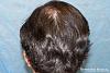 Click image for larger version

Name:	08_after-hair-transplant-back-view.jpg

Size:	29.9 KB
ID:	44737