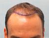 Click image for larger version

Name:	1b_position-of-hairline_acb.jpg

Size:	90.1 KB
ID:	47617