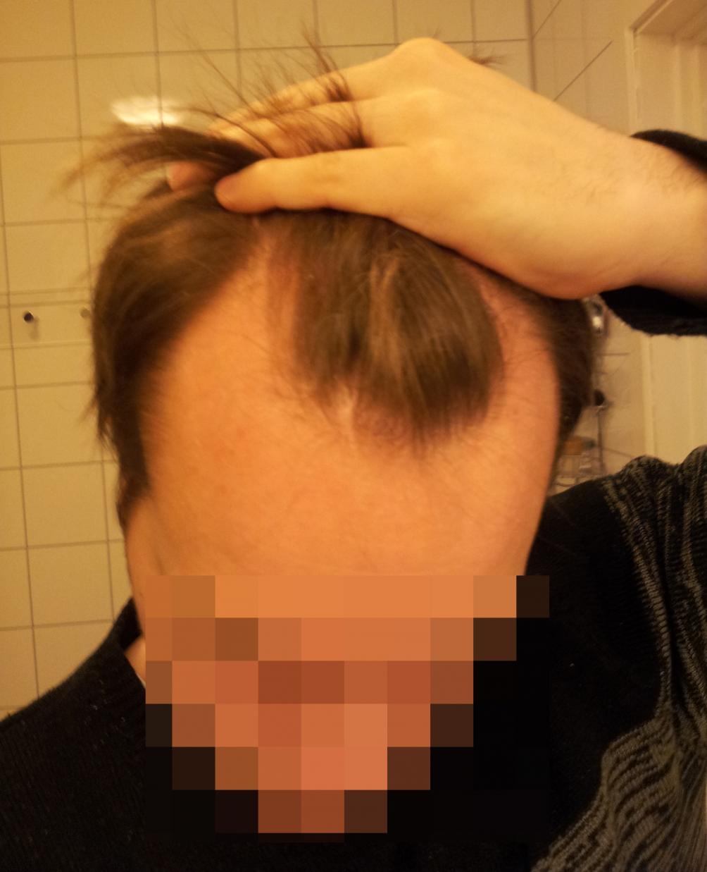 Click image for larger version

Name:	Me hairline.jpg

Size:	81.5 KB
ID:	20575