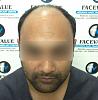 1Before and After Hair transplant done at face value clinic