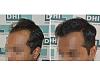 sukrut, 26 yrs, 3430 hair implanted, 6 months result