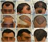hair Implanted 4861, 8 months