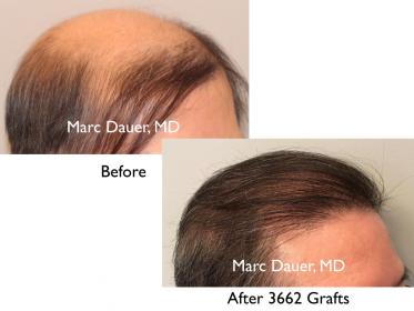 Click image for larger version

Name:	Hair Transplant Slides copy15.008.jpg

Size:	13.4 KB
ID:	43891