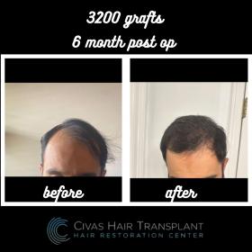 Procedure: FUE Hair Transplant 
Number of grafts: 3200 Grafts 
Results: 6 Months Post-op