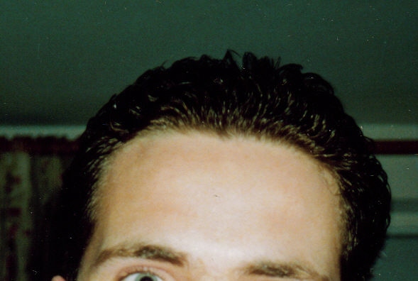 hairline in 1992 aged 19