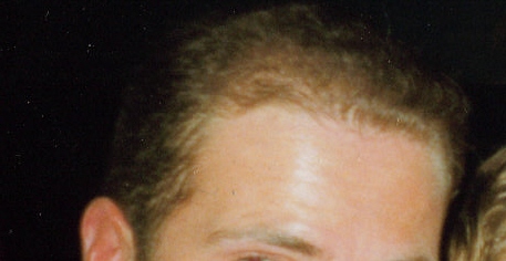 My Hair in 1996 just after my first surgery aged 23