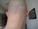 (091212) repaired strip scar December 12, 2009 - at zero setting of electric hair shear - after 3 FUE graft sessions into the scar.  I realize my...