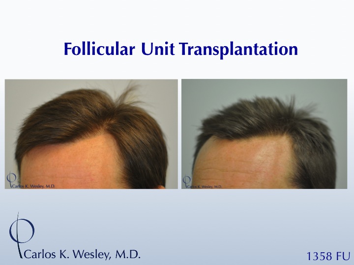 Before/After 1358 grafts to hairline and part line with Dr. Wesley in NYC.