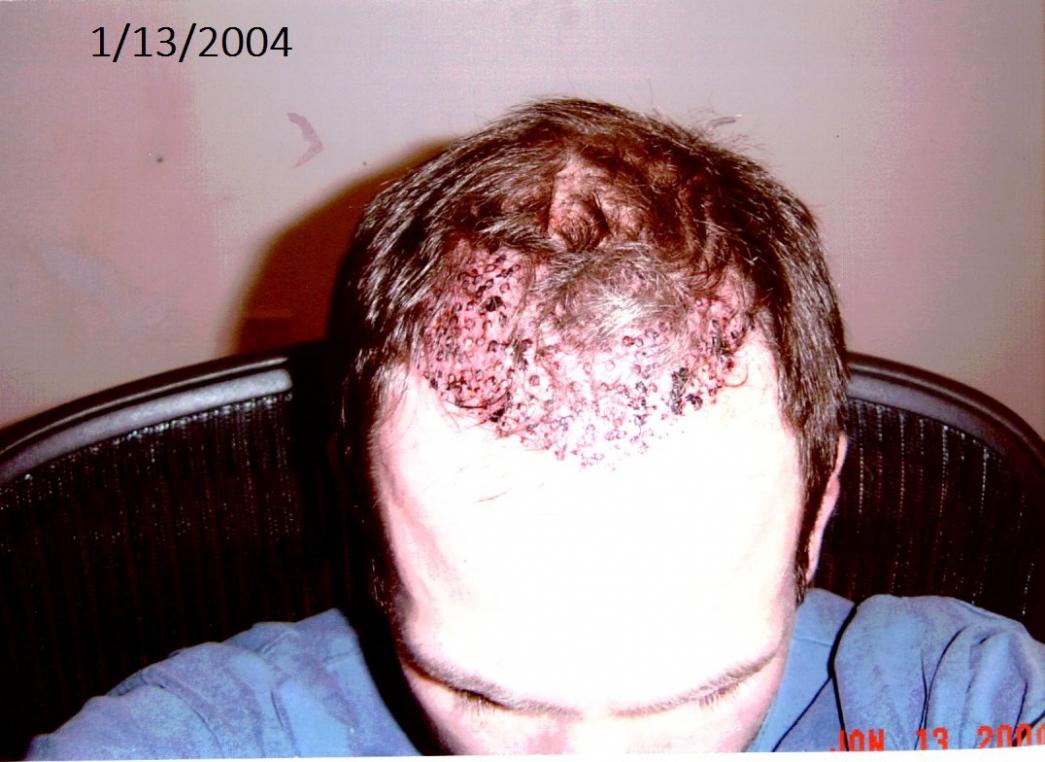 Click image for larger version

Name:	2004_hair_1day_after.jpg

Size:	90.5 KB
ID:	36723