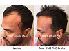 Click image for larger version

Name:	Hair Transplant Slides copy113.002.jpg

Size:	16.8 KB
ID:	48327