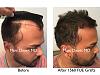 Click image for larger version

Name:	Hair Transplant Slides copy113.003.jpg

Size:	17.4 KB
ID:	48328