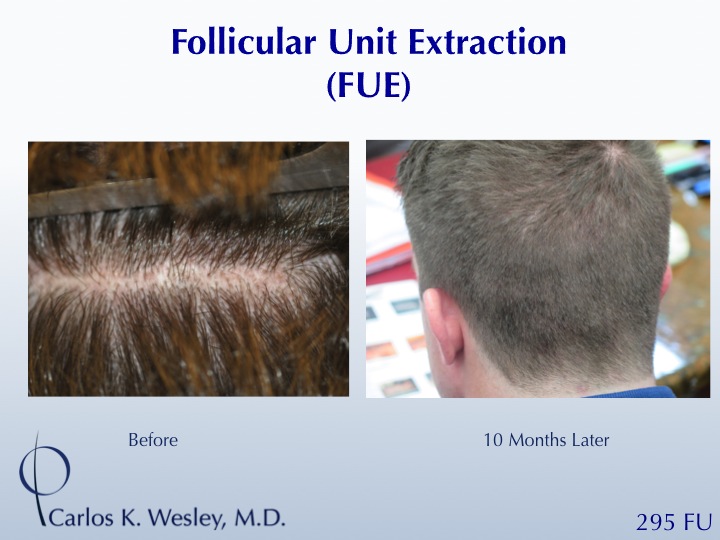 FUE to erase a prior donor scar