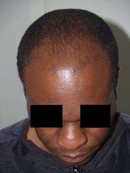 Before Hair Transplant