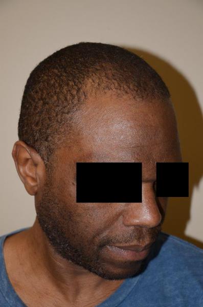 After Hair Transplant