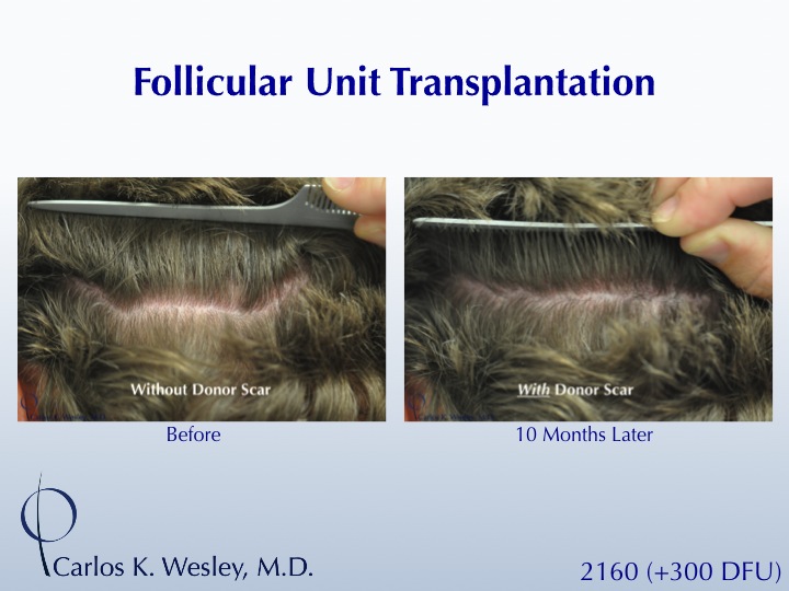 A 40-year-old male underwent a 2460 FU session of FUT with Dr. Carlos K. Wesley (NYC).  His donor area afterwards.