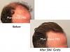 Click image for larger version

Name:	Hair Transplant Slides copy15.003.jpg

Size:	12.5 KB
ID:	45704