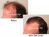 Click image for larger version

Name:	Hair Transplant Slides copy15.002.jpg

Size:	12.6 KB
ID:	45705