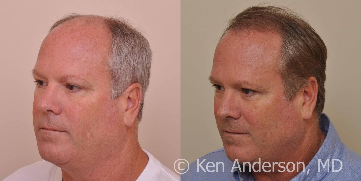 Linear Strip Hair Transplant Results at 6 months - Anderson Center for Hair