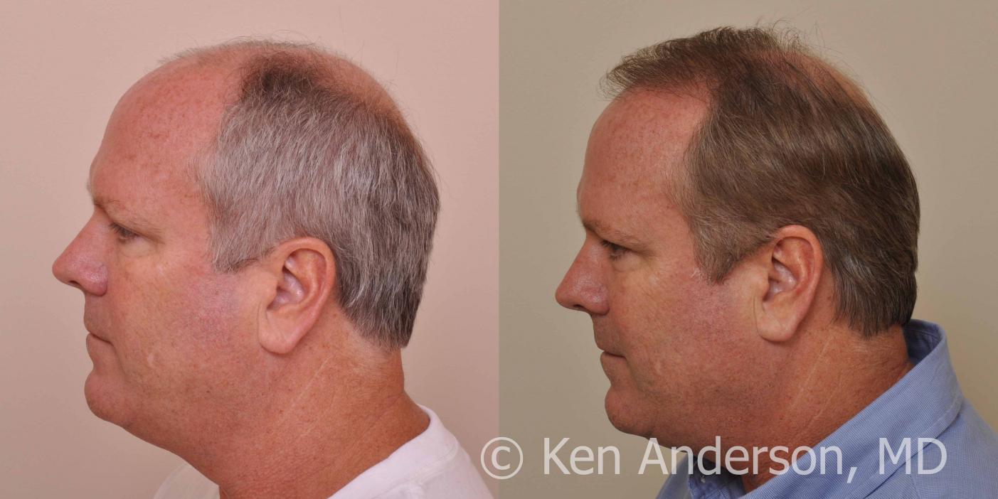 Linear Strip Hair Transplant Results at 6 months - Anderson Center for Hair