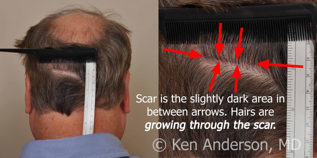 Linear Strip Hair Transplant Results at 6 months - Anderson Center for Hair