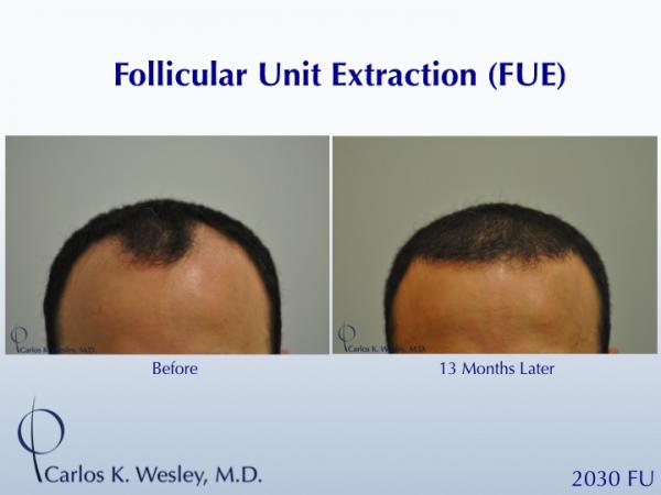 Before and 13 months after FUE with Carlos K. Wesley (NYC).