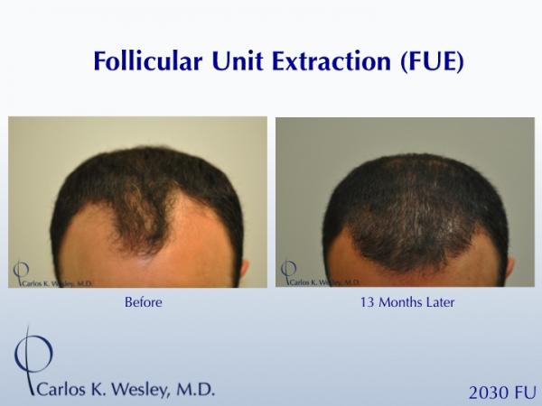 Before and 13 months after FUE with Carlos K. Wesley (NYC).